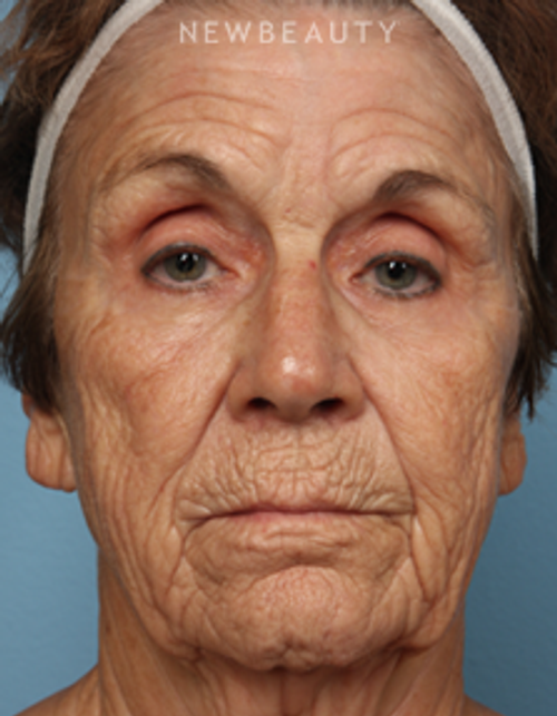 Dr. Kathleen Behr - Injectables & Fillers - Before