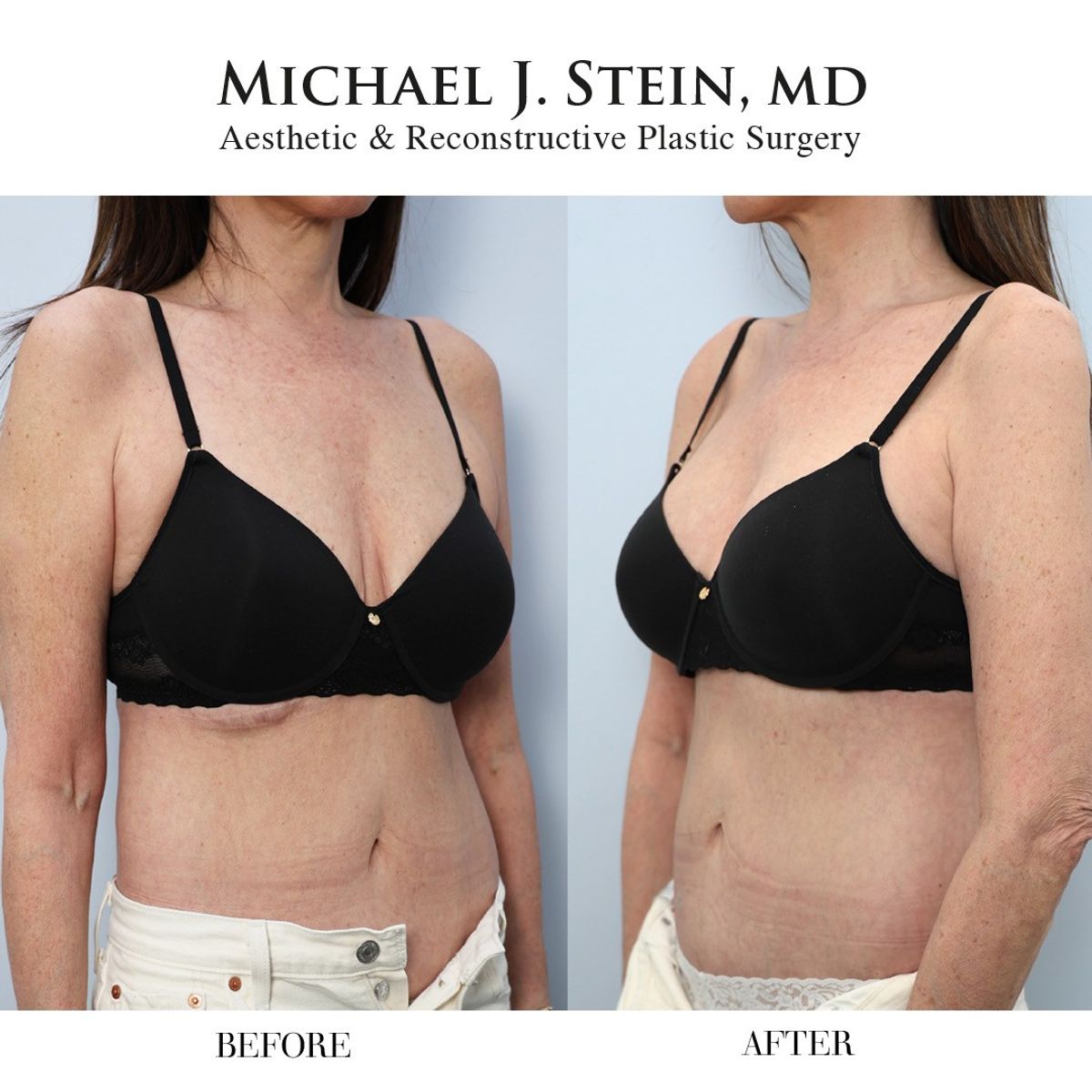 before and after breast revision