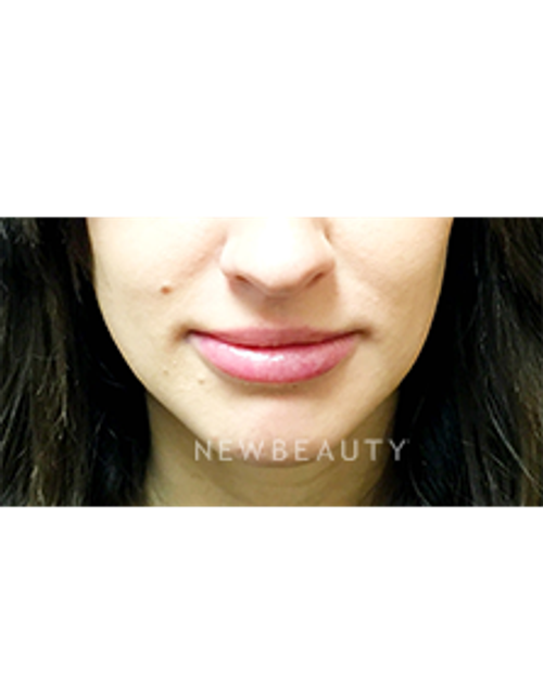 Dr. Jeffrey B. Wise - Lip Enhancement - After