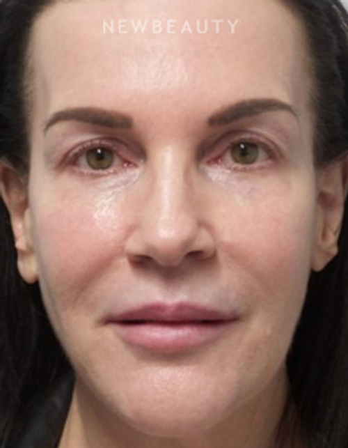 Dr. Marina Peredo - Facelift - Before