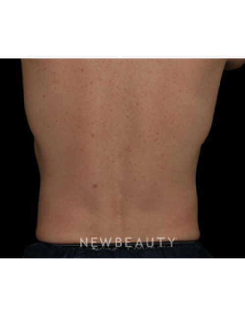 Dr. Jennifer Segal - CoolSculpting - After