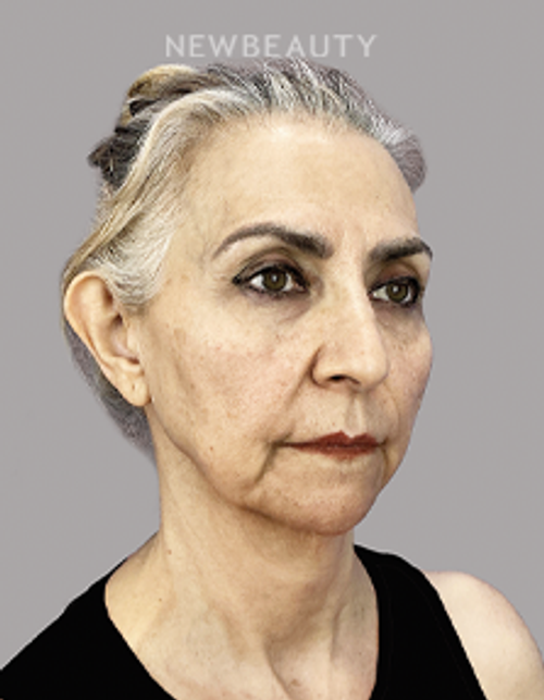 Dr. Sheila Barbarino-Thread Lift-54798899 - Before