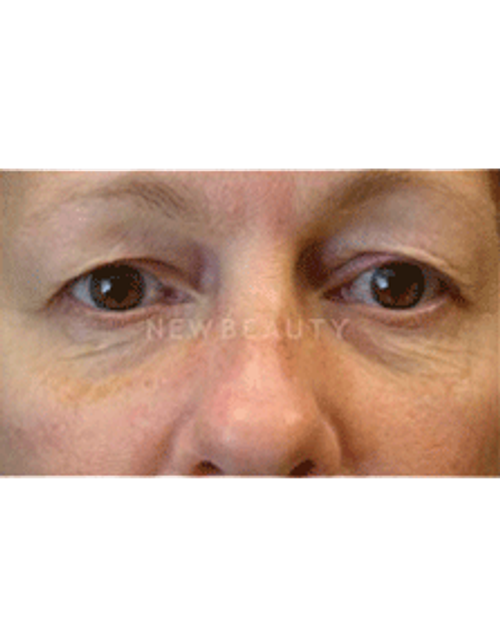 Dr. Phillip Chang Eyelift - Before