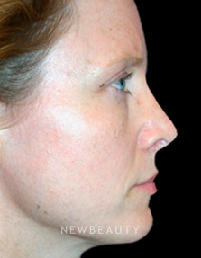 Dr. Kelly Bomer Rhinoplasty - After