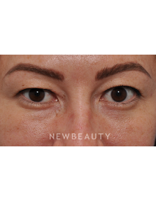 Dr. Edward Kwak - Upper Blepharoplasty - Before