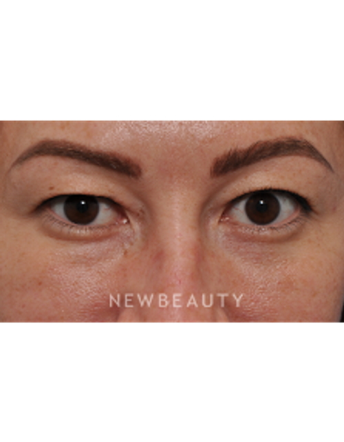 Dr. Edward Kwak - Upper Blepharoplasty - Before