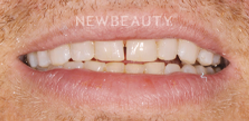 Dr. Salvator La Mastra - Smile Makeover -46106734 - Before