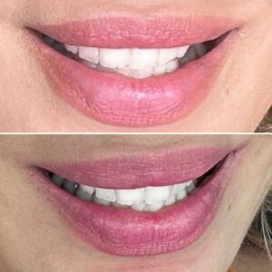 RHA 3 Lip Injections