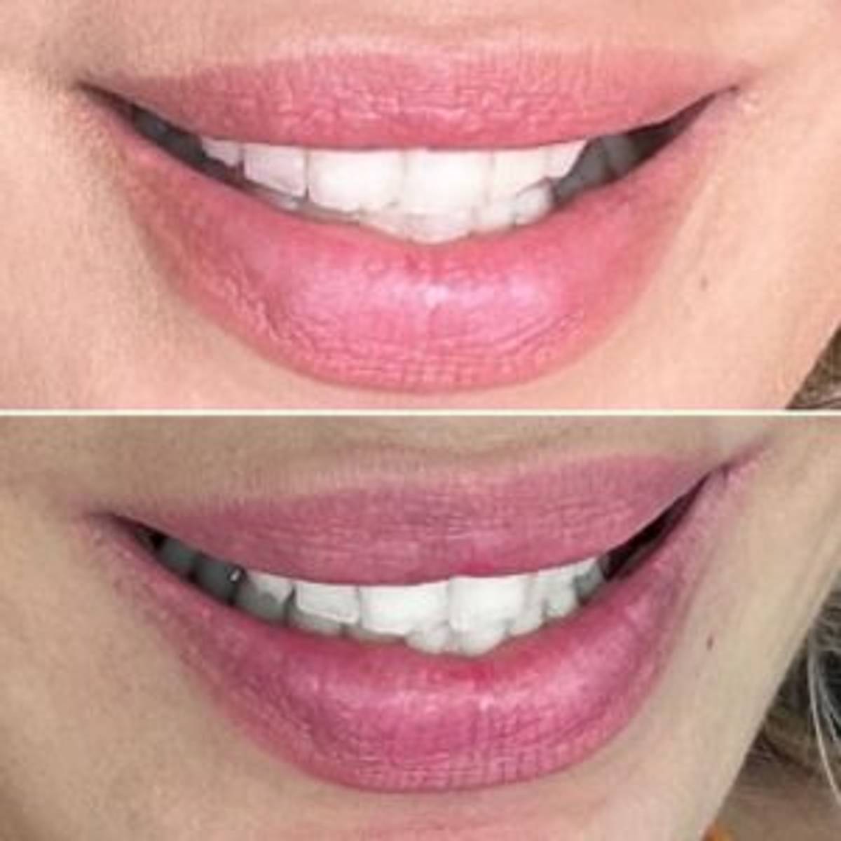 RHA 3 Lip Injections