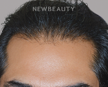 Dr. Anthony Bared - Hair Transplant - 46164563 - After