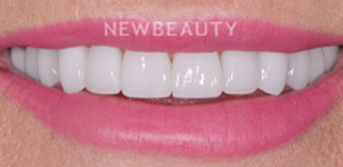 Dr. Salvator La Mastra - Smile Makeover -46100874 - After