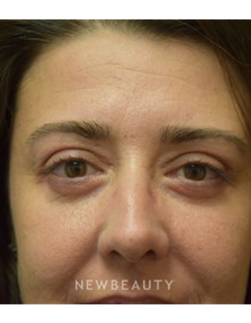 Dr. Jeffrey B. Wise - Eyelift - After
