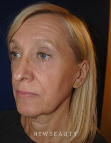 Dr. Lee Ann Klausner - Mini Facelift - Before