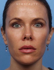 Dr. Kelly Bomer - Liquid Facelift - After