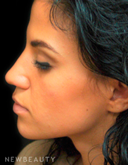 Dr. Mokhtar Asaadi Rhinoplasty - After