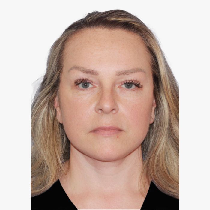 after facelift necklift