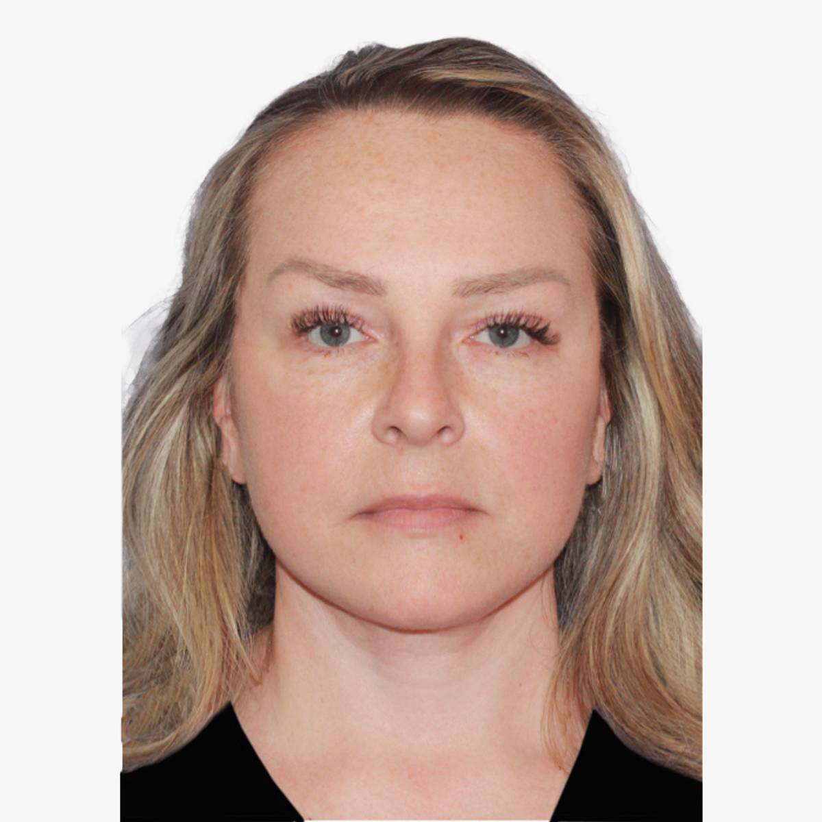 after facelift necklift