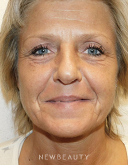 Dr. Joel Schlessinger - Injectables & Fillers - Before