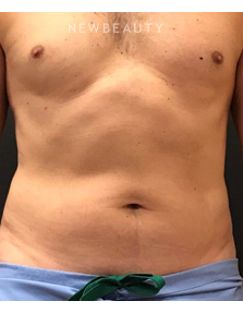 Dr. Janet Allenby - CoolSculpting - After