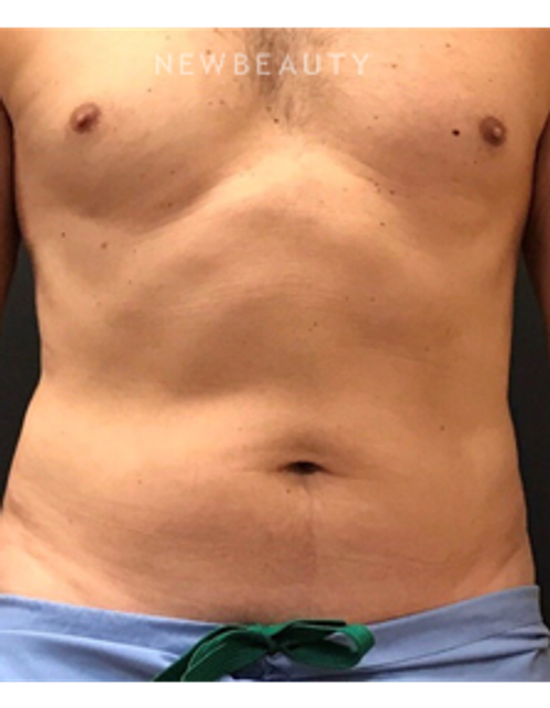 Dr. Janet Allenby - CoolSculpting - After