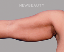 Dr. Peter Vonu - Sleeker Arms - Before