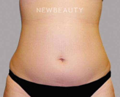 Dr. Sanjay Grover - Liposuction - 49728211 - Before