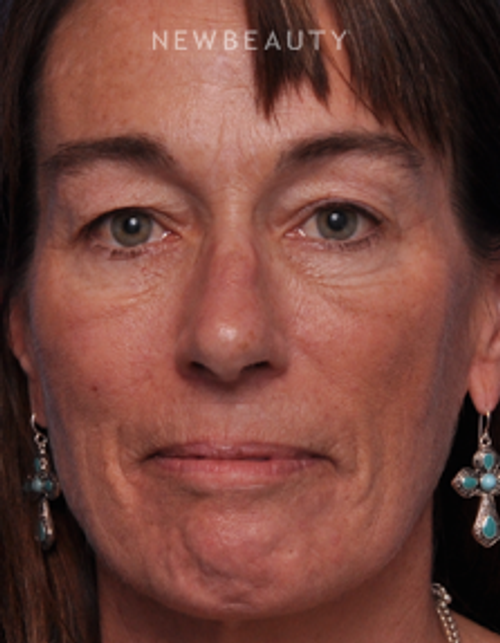 Dr. Alan J. Durkin - Eyelift - Before