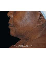 Dr. Lee Ann Klausner Ulthera Skin Tightener - Before