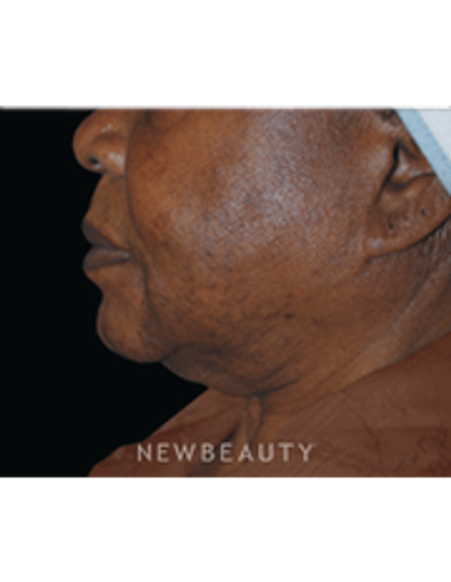 Dr. Lee Ann Klausner Ulthera Skin Tightener - Before