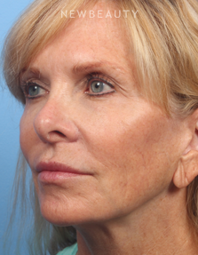Dr. Kelly Bomer - Liquid Facelift - After