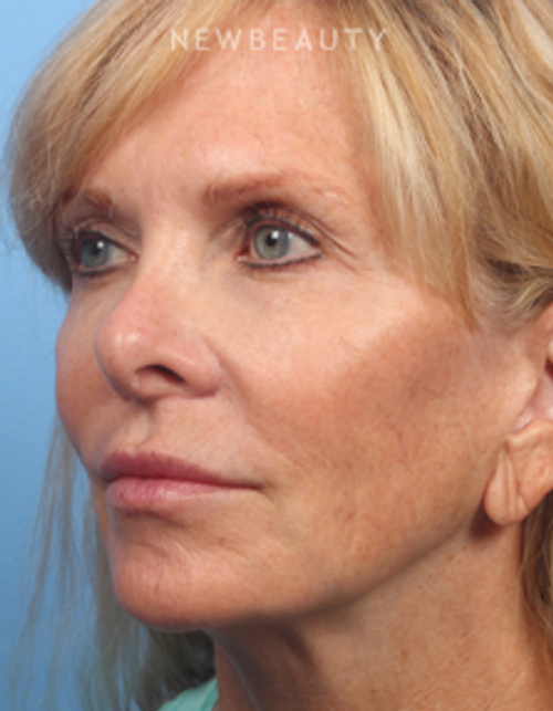 Dr. Kelly Bomer - Liquid Facelift - After