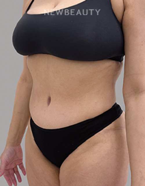 Dr.Drew Schnitt - Abdominoplasty - 46167716 - After
