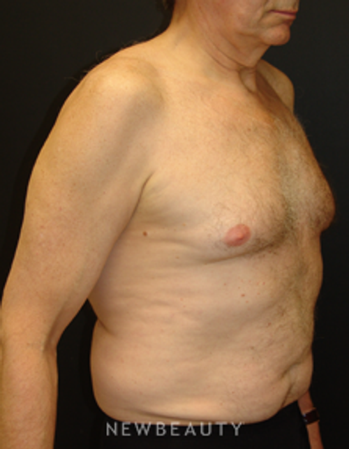 Dr. Mokhtar Asaadi Liposuction - Before