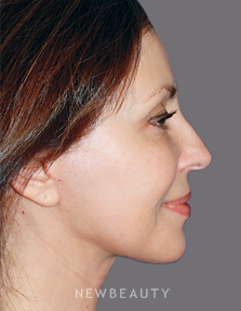 Dr. Konstantin Vasyukevich Facelift, Necklift - After