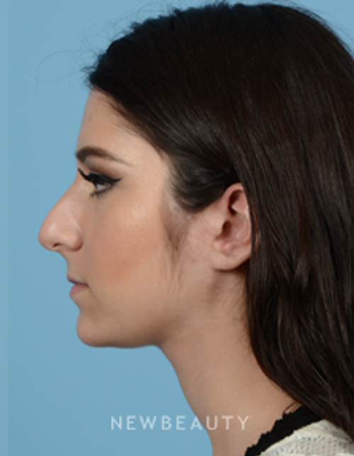 Dr. Jeffrey B. Wise - Rhinoplasty - Before