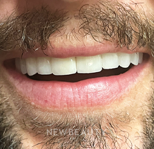 Dr. Lana Rozenberg - Smile Makeover - 47194480 - After