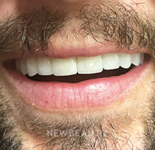 Dr. Lana Rozenberg - Smile Makeover - 47194480 - After