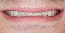 Dr. Nathan Hoffman - Crowns & Veneers - Before