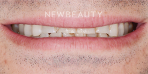 Dr. Nathan Hoffman - Crowns & Veneers - Before