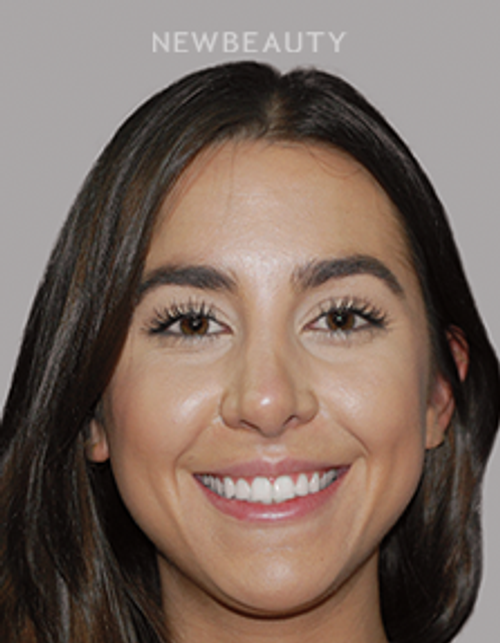 Dr. Salvator La Mastra - Smile Makeover -46108782 - Before