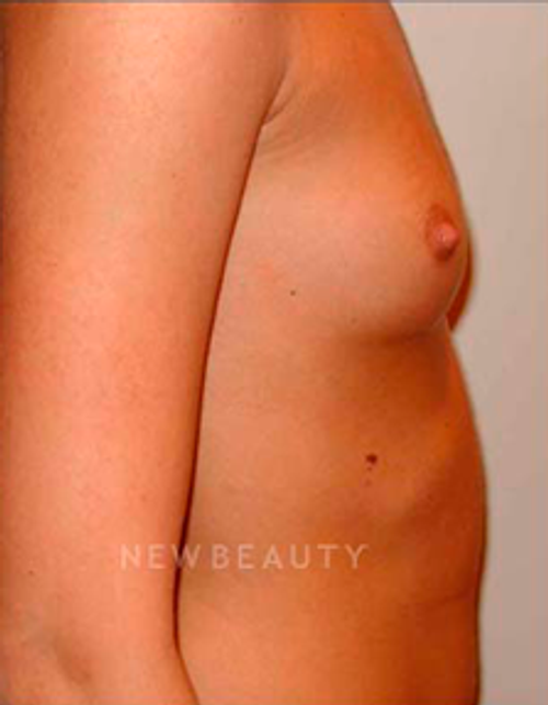 Dr. Michael Horn Saline Breast Implants - Before