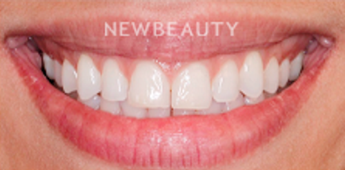 Dr. Victoria Veytsman - Smile Makeover - Before