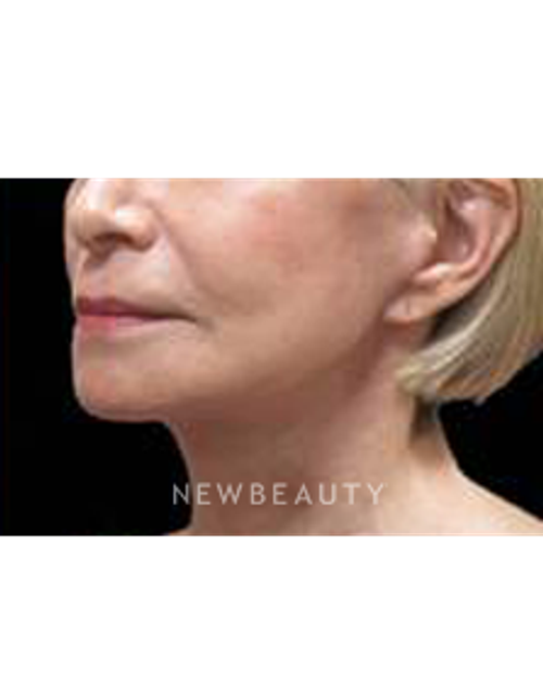 Dr. Elie Levine - Facelift - After