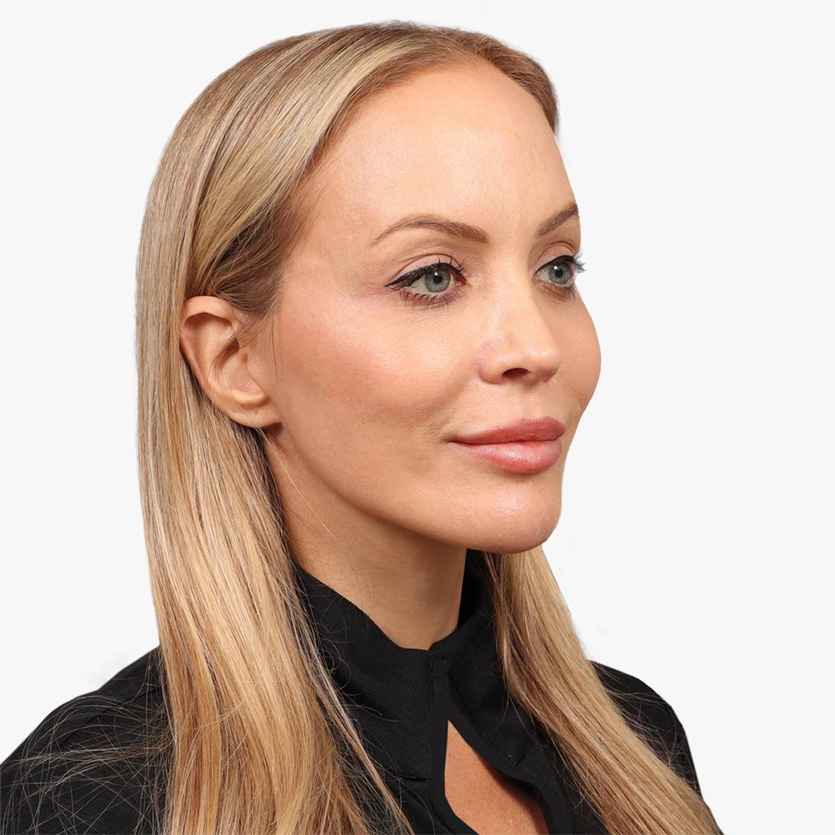 After browlift, facelift, necklift and fat transfer 