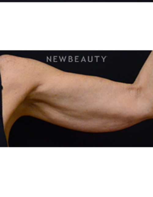 Dr. Mokhtar Asaadi - Arm Lift - Before