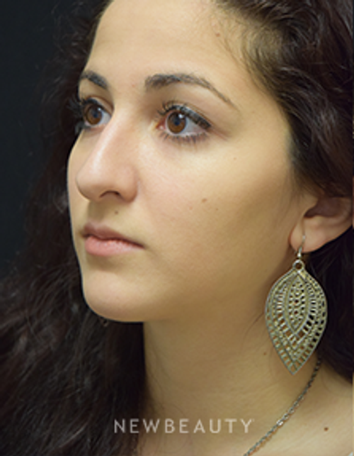 Dr. Jeffrey B. Wise - Rhinoplasty - Before