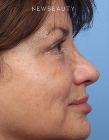 Dr. Kelly Bomer - Pleasant Profile - Before
