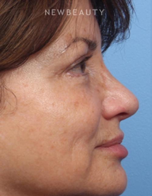 Dr. Kelly Bomer - Pleasant Profile - Before