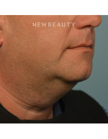 Dr. Ruth Hillelson - Tighter and Firmer - Before