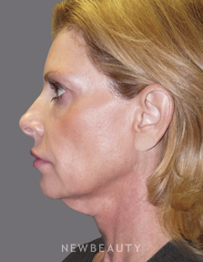 Dr. Andrew Ordon Facelift, Necklift, Chemical Peel, Injectables & Fillers, Lasers - Before